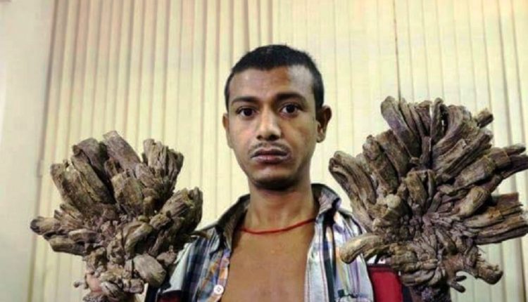 “الرجل الشجرة” يطلب قطع يديه بعد عدم جدوى 25 عملية